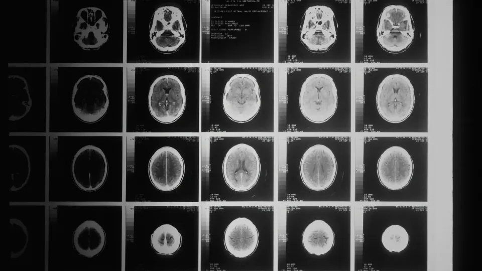 Smegenys keičia formą: mokslininkai rado ženklą, kuris išduoda artėjančią demenciją dar iki simptomų