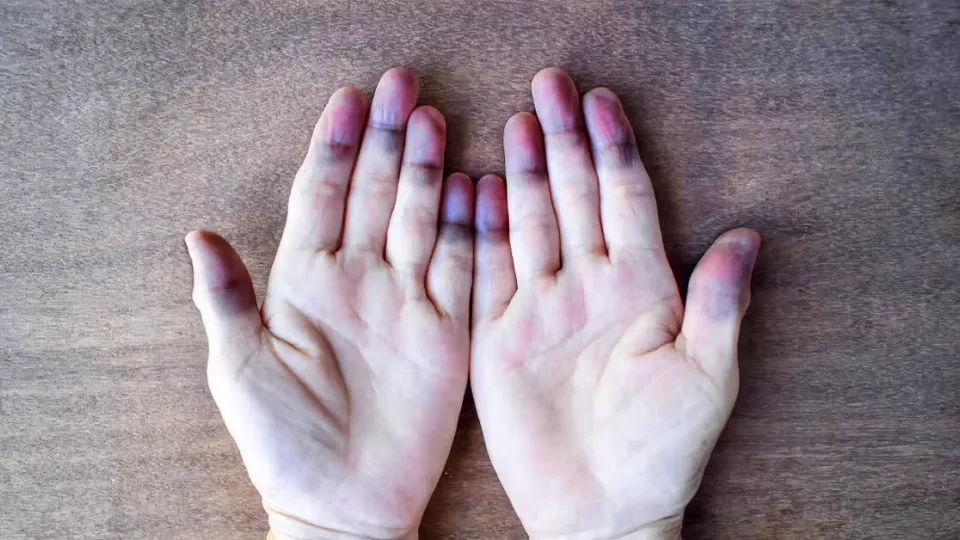 Kodėl mėlynuoja pirštai? Šie simptomai gali reikšti rimtą kraujotakos ar kvėpavimo sutrikimą
