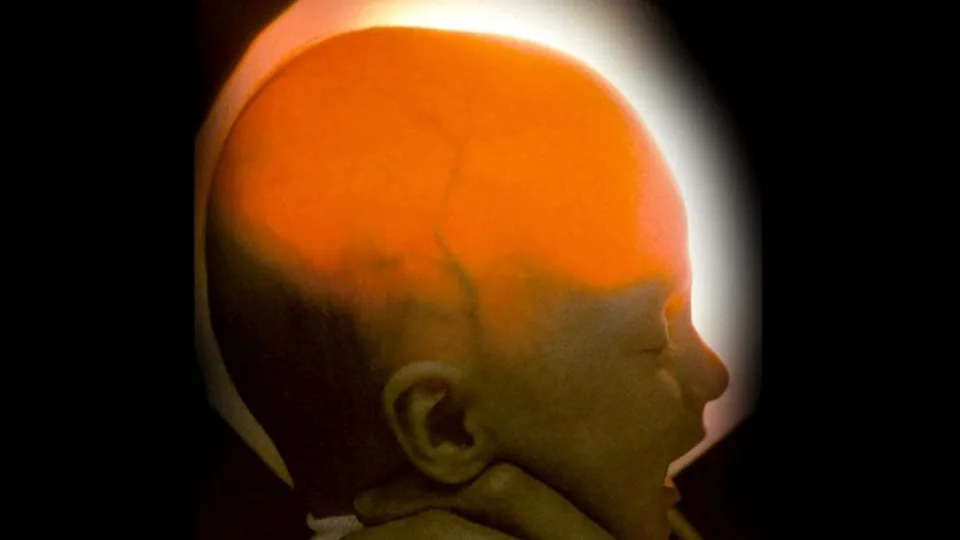 Medikai netikėjo, kad išgyvens: gimė be didžiosios smegenų dalies, bet vis dar gyva po 20 metų