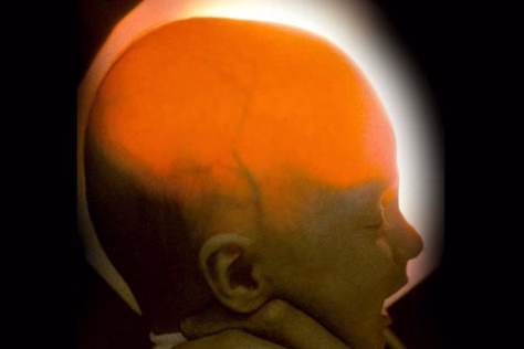 Medikai netikėjo, kad išgyvens: gimė be didžiosios smegenų dalies, bet vis dar gyva po 20 metų