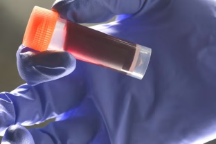 Ankstyvas insultas dažniau ištinka turinčius šią kraujo grupę, ką atskleidė naujas tyrimas