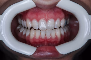 Ar burnos skalavimo skystis tikrai būtinas kasdienėje higienoje? Atsakymas gali nustebinti