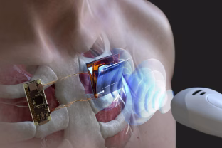 Pacientų laukia perversmas medicinoje: nauja technologija leis įkrauti širdies implantus be operacijos