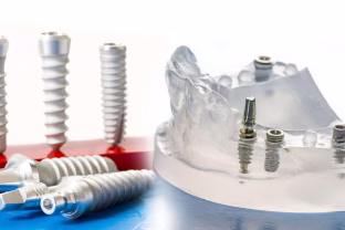 Ar dantų implantai iš tiesų gali tarnauti visą gyvenimą? Gydytojas paaiškino, kaip yra iš tikrųjų