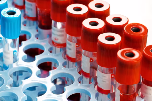 Ką apie tavo ateitį sako kraujas? Baltymai gali įspėti apie rizikas anksčiau nei gydytojai