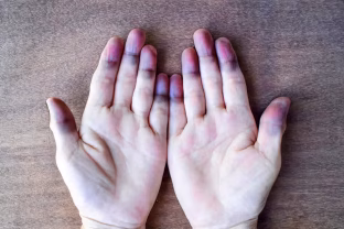 Kodėl mėlynuoja pirštai? Šie simptomai gali reikšti rimtą kraujotakos ar kvėpavimo sutrikimą