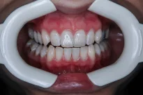 Ar burnos skalavimo skystis tikrai būtinas kasdienėje higienoje? Atsakymas gali nustebinti