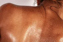 Gydytoja perspėja: dažna žarnyno problema, kurią ignoruoja lietuviai, baigiasi bėrimais visame kūne