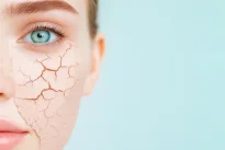 Jei žiemą odą tempia ir ji rausta, šis paprastas namų receptas gali pakeisti viską